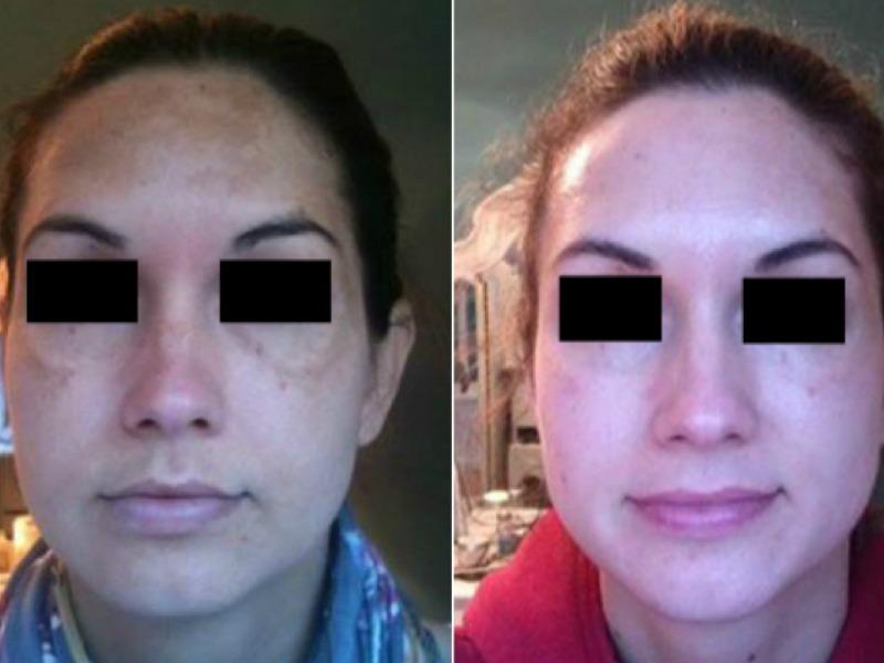 before-after-how-to-heal-sun-damage-and-melasma-medico-beauty