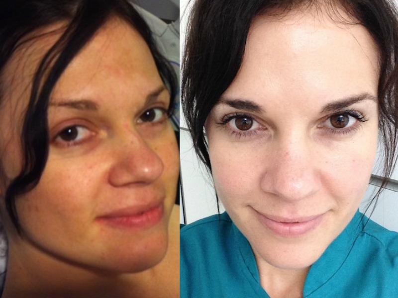 Before & After: Peels that Heal Hyperpigmentation and Even Out Skin To ...